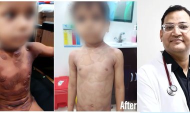 फेलिक्स हॉस्पिटल में स्टैफिलोकोकल स्कैल्डेड स्किन सिंड्रोम से पीड़ित बच्चे का सफल इलाज