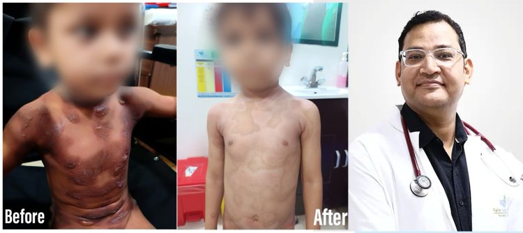 फेलिक्स हॉस्पिटल में स्टैफिलोकोकल स्कैल्डेड स्किन सिंड्रोम से पीड़ित बच्चे का सफल इलाज
